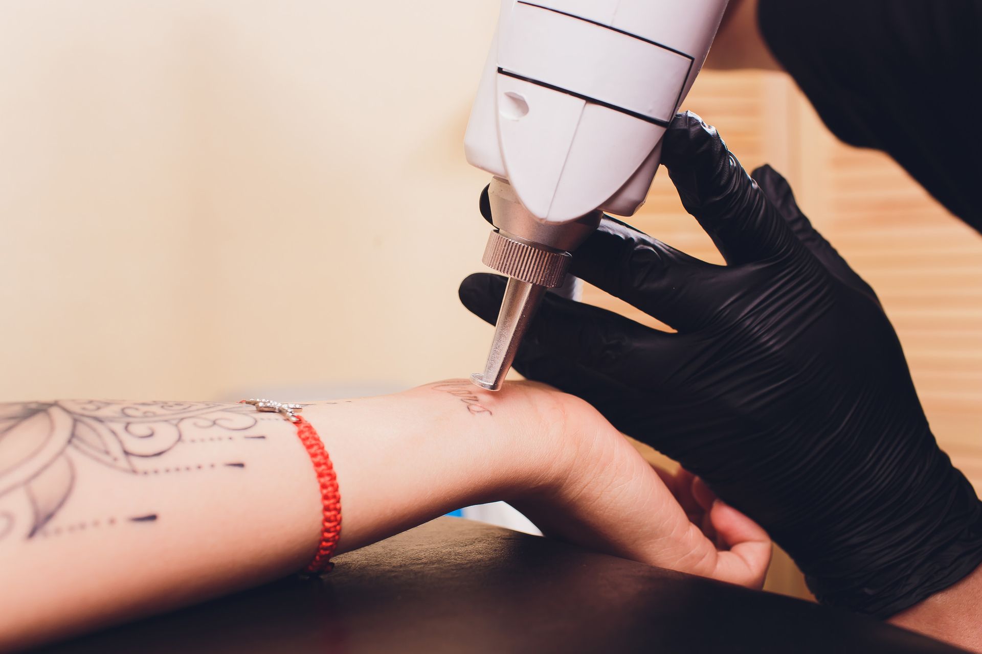 Una persona se está eliminando un tatuaje de la muñeca.
