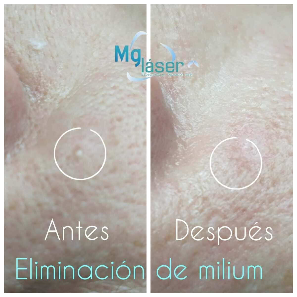 Antes y después de la eliminación de un milium en la piel, con áreas marcadas en círculos blancos.