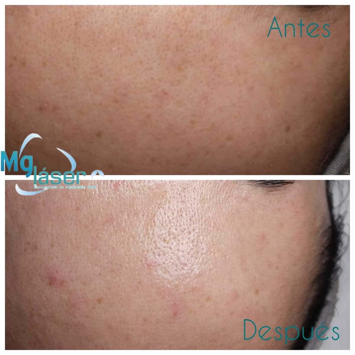 Primer plano de la piel del rostro antes y después del tratamiento, que muestra una reducción de las imperfecciones y una textura más suave.