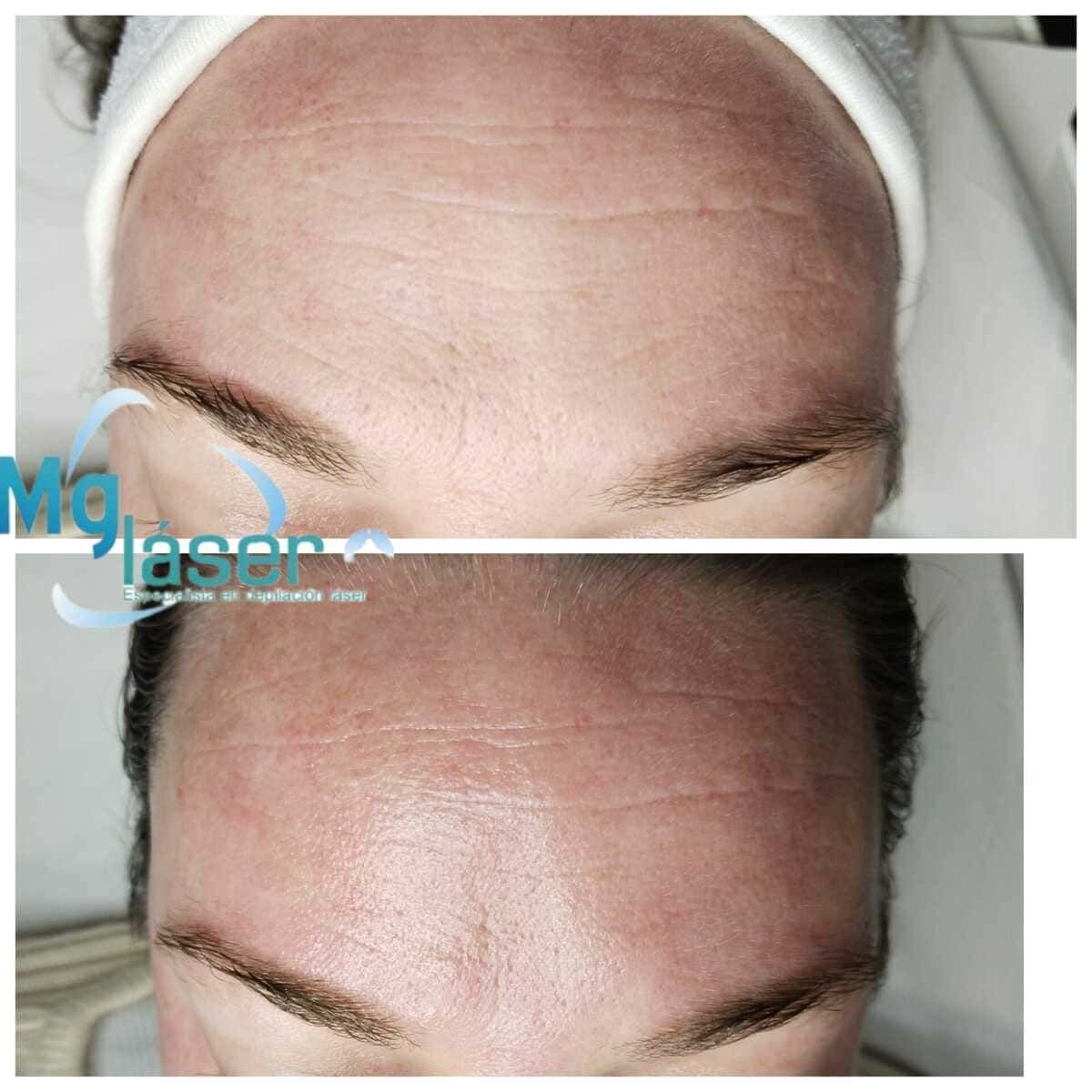 Primer plano de una frente con depilación de cejas, antes y después de la depilación. Imágenes comparativas superior e inferior.