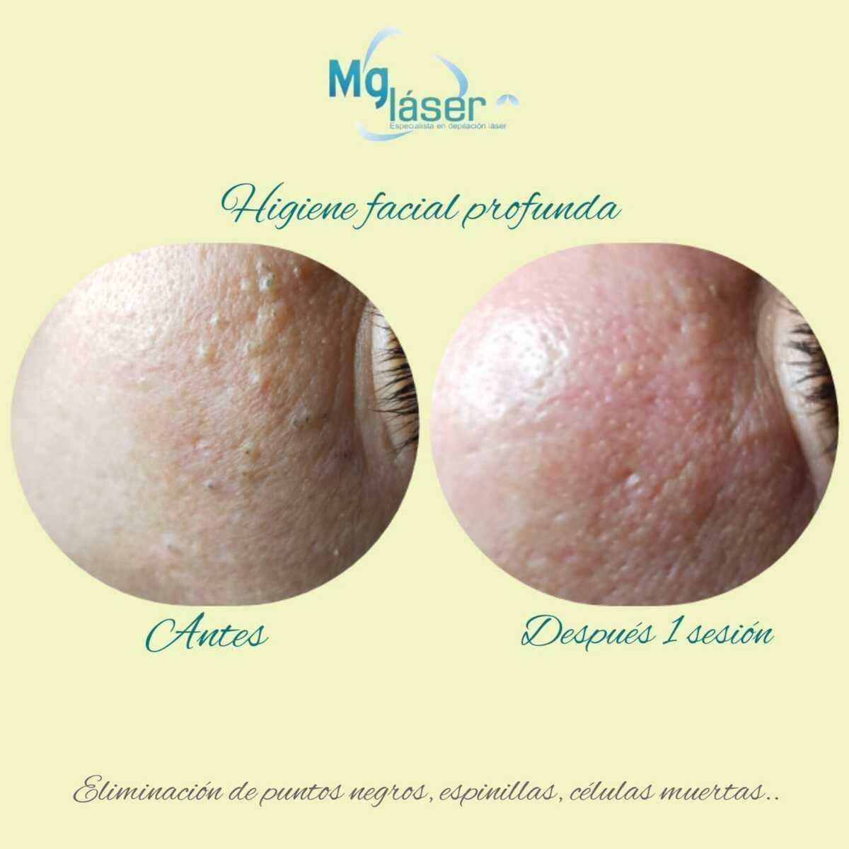 Primer plano de la textura de la piel del rostro antes y después del tratamiento, etiquetado como