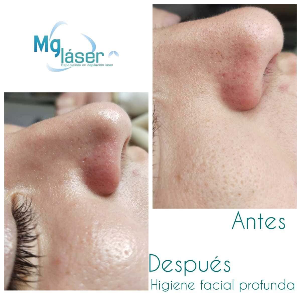 Primer plano de una nariz con una protuberancia en relieve, etiquetada en español como “Antes” y “Después”, con el logotipo de Mg Laser.