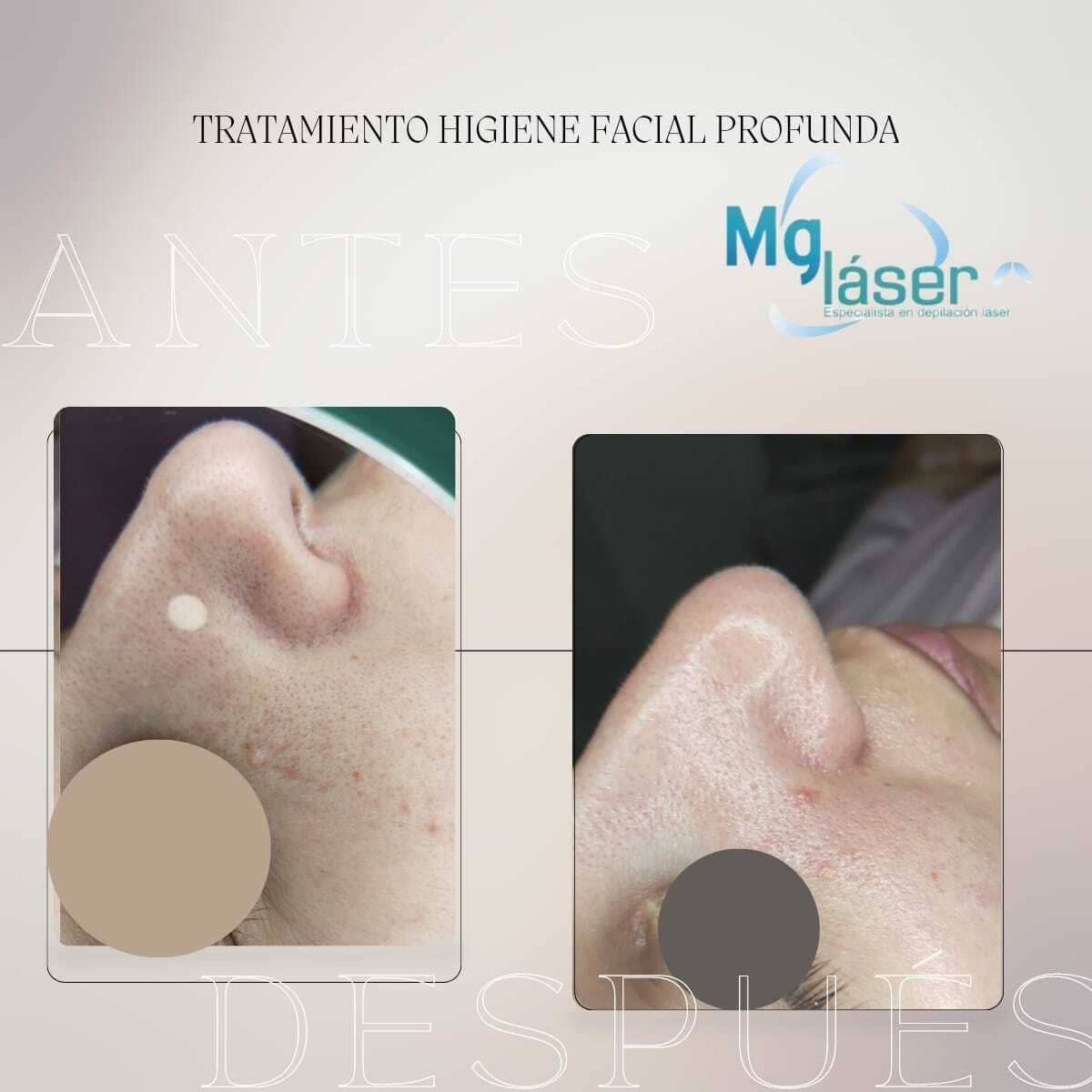 Primeros planos de las mejillas, uno al lado del otro, etiquetados como antes y después del tratamiento láser para una lesión cutánea facial.