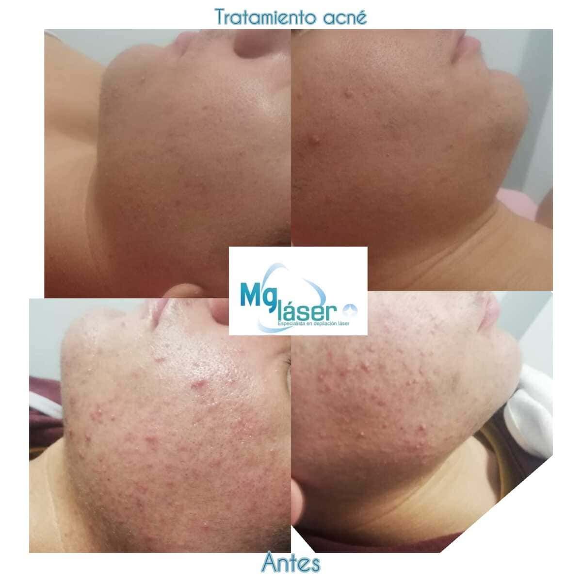 Fotografías del antes y el después del tratamiento para el acné, que muestran la barbilla y la mandíbula de una persona con una reducción de las imperfecciones y el enrojecimiento.