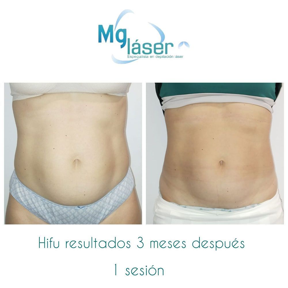 Fotos del torso antes y después que muestran un abdomen más plano después de 1 sesión de HIFU, con el texto en español “Resultados HIFU 3 meses después”.
