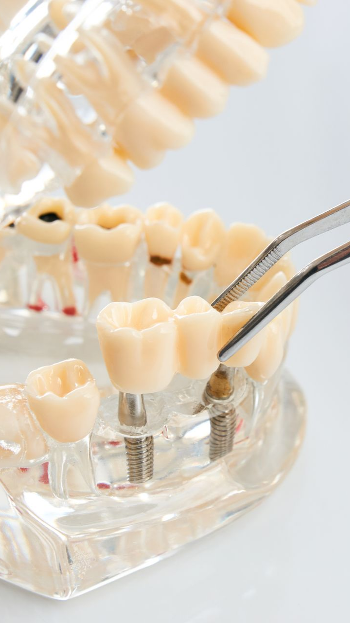 Modèle d'implant dentaire avec pont placé à l'aide de pinces métalliques.