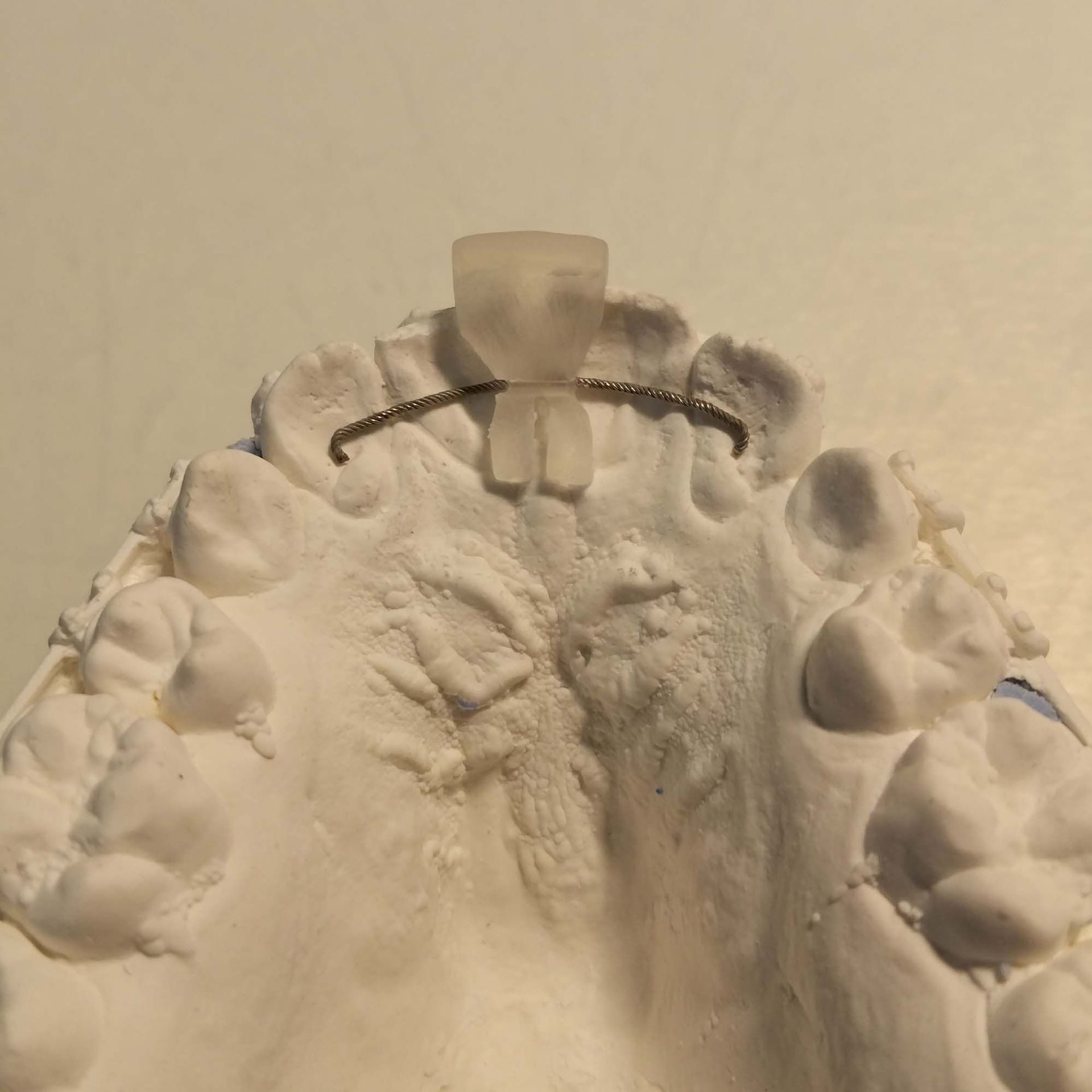 Retainer / Schiene - Zahntechnik Jentsch in Brig-Glis