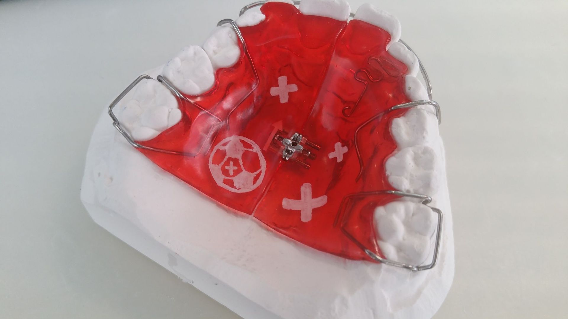 Aufbissplatte - Zahntechnik Jentsch in Brig-Glis