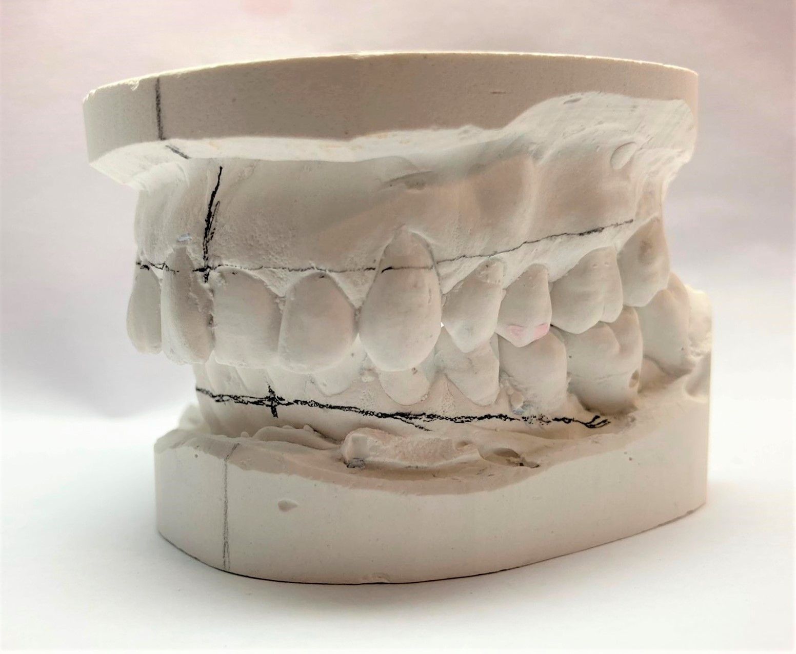 Lingualbogen - Zahntechnik Jentsch in Brig-Glis