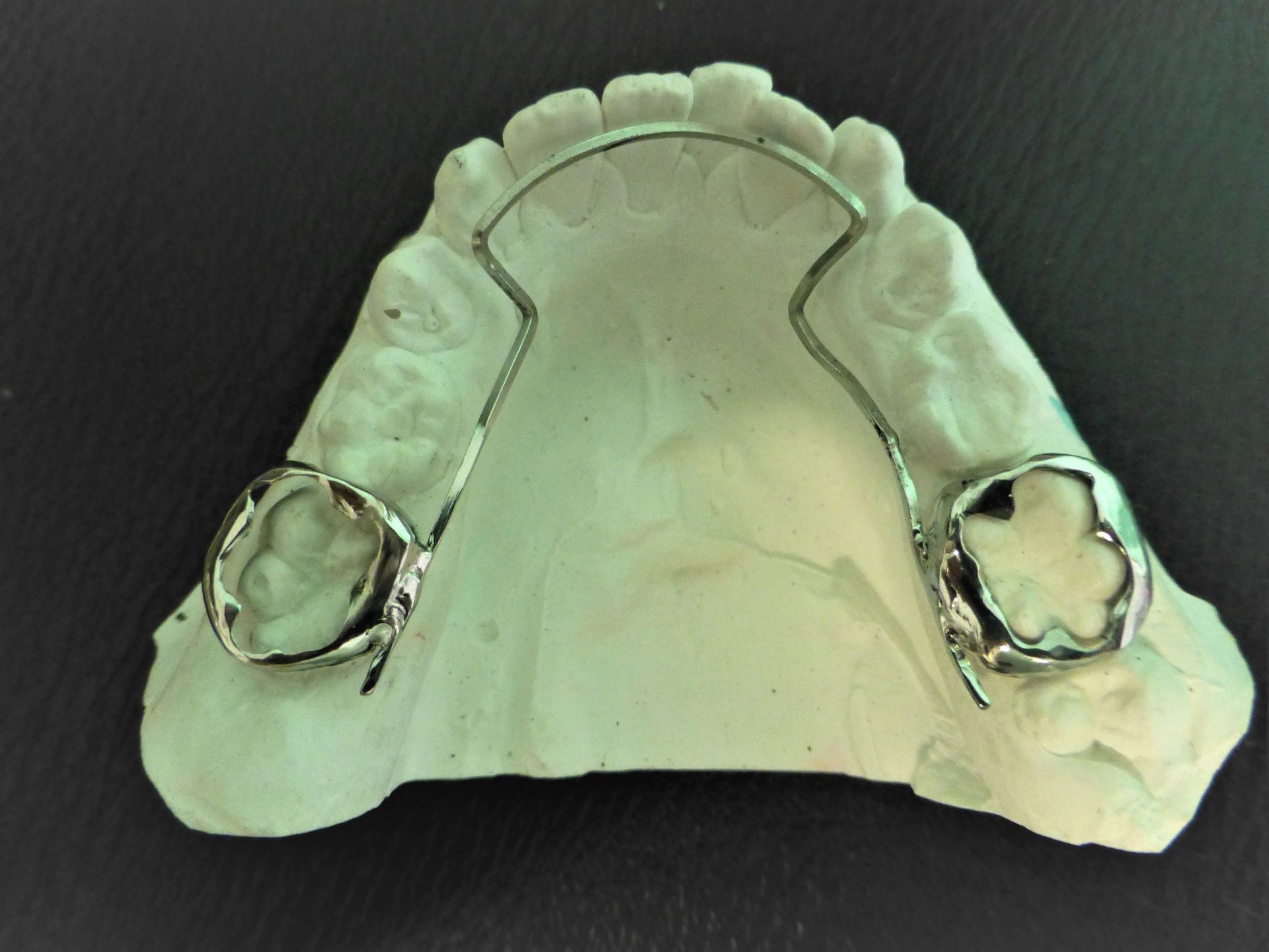 Lingualbogen - Zahntechnik Jentsch in Brig-Glis