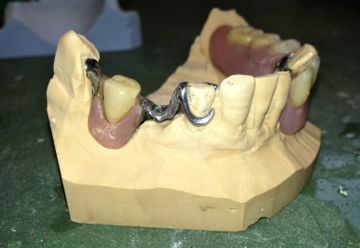 Lingualbogen - Zahntechnik Jentsch in Brig-Glis