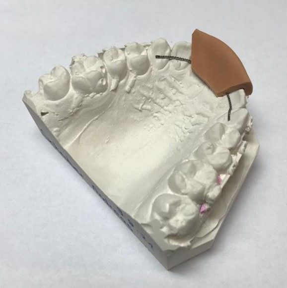 Lingualbogen - Zahntechnik Jentsch in Brig-Glis