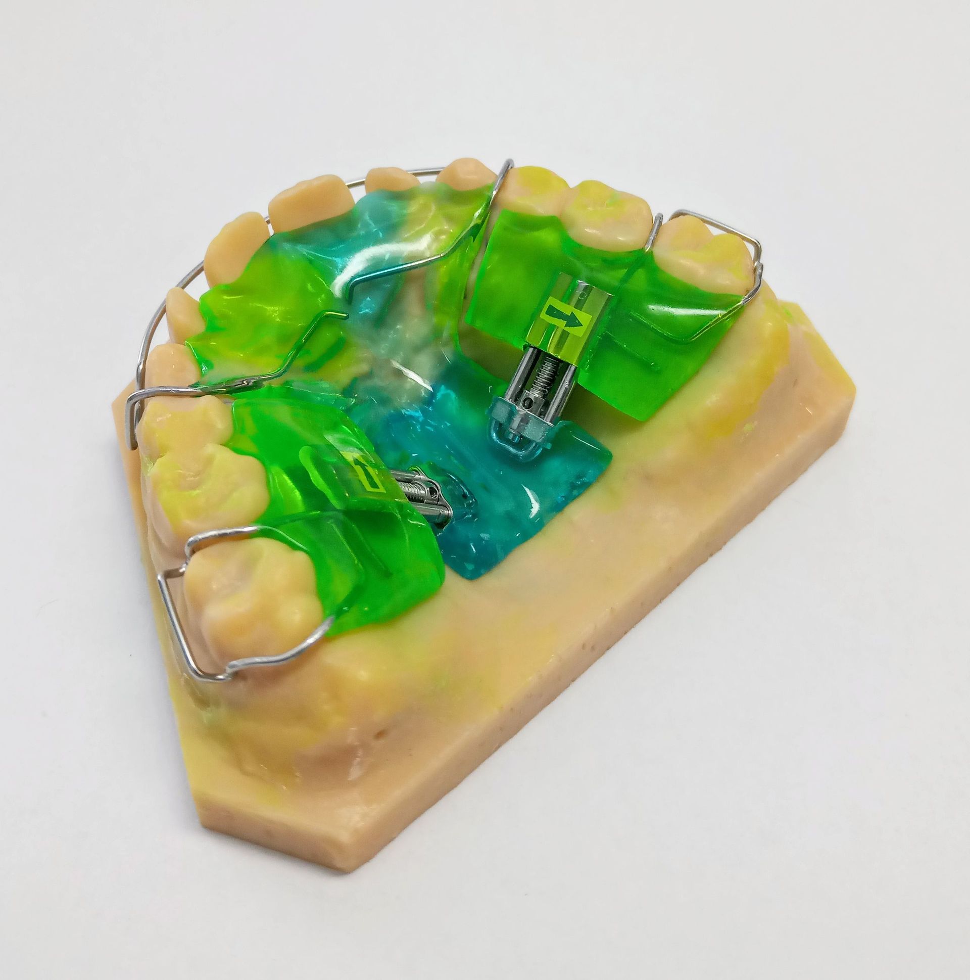 Dehnplatte - Zahntechnik Jentsch in Brig-Glis