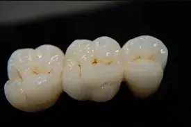 Un primer plano de tres dientes blancos sobre un fondo negro.