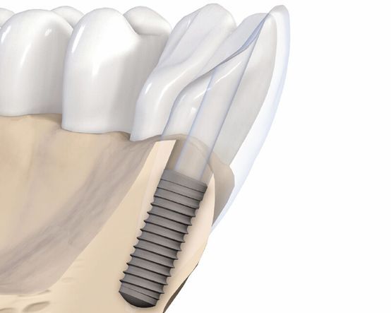 Zahnarztpraxis Dr. Andreas Pausch, Implantologie, Tragekomfort, Kaufunktion, Einzelzahnimplantat, Teilbezahnung, Zahnloser Kiefer, Knochenaufbau, Festsitzende Lösungen