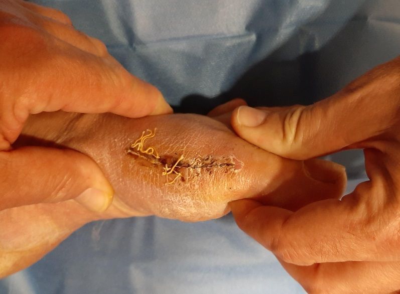 Una persona sostiene una mano con una puntada en ella.