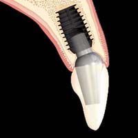 Se inserta un implante dental en un diente.