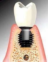 Un diente con un implante dental en él.