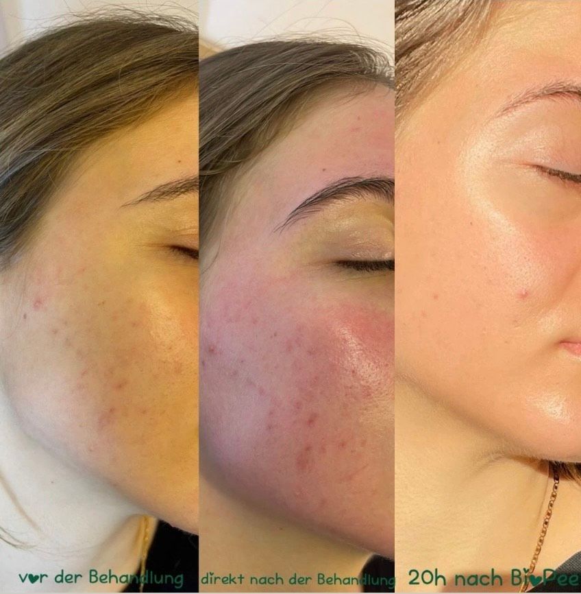 Vorher Nachher Bilder Gesichtsbehandlung