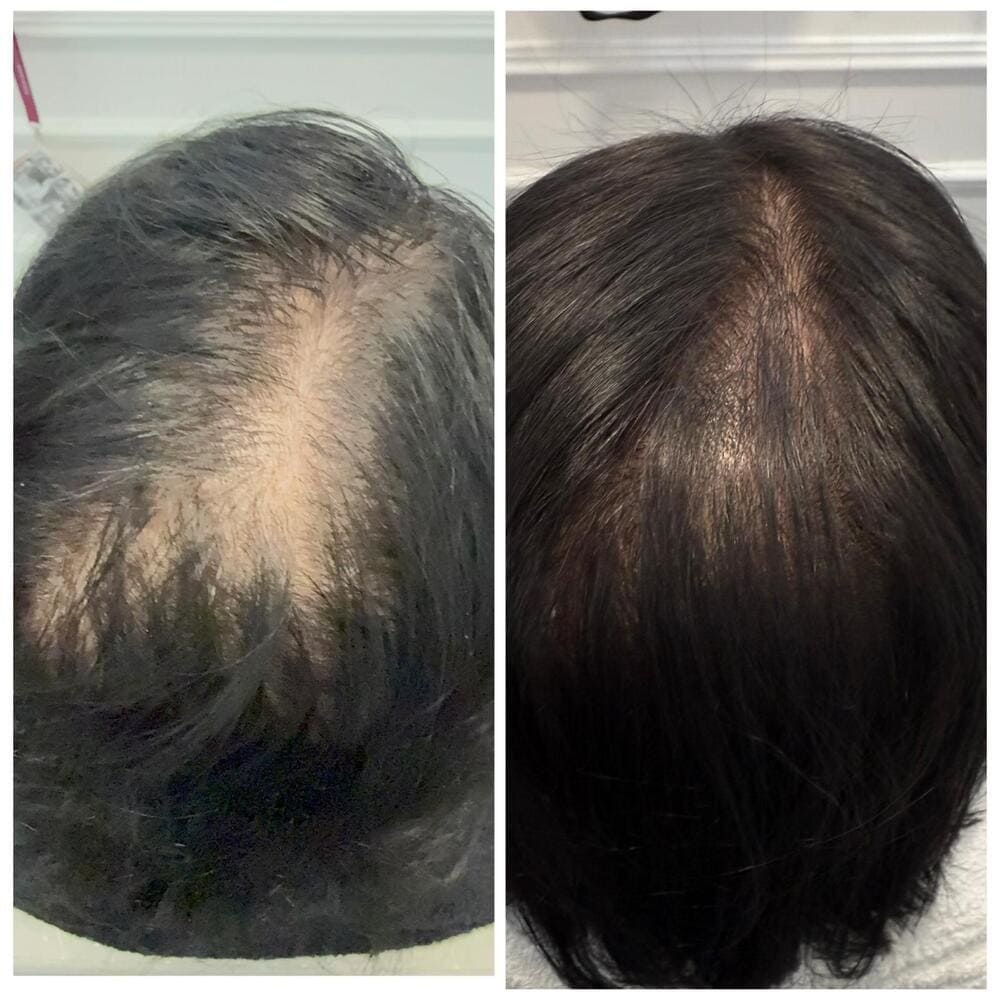 Se muestra la parte superior del cuero cabelludo antes y después del tratamiento, con cabello más fino a la izquierda y mayor densidad a la derecha.