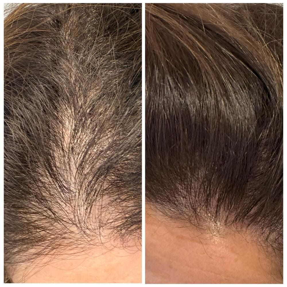 Primer plano comparativo del adelgazamiento de la línea del cabello antes y después, con el cabello más abundante a la derecha.