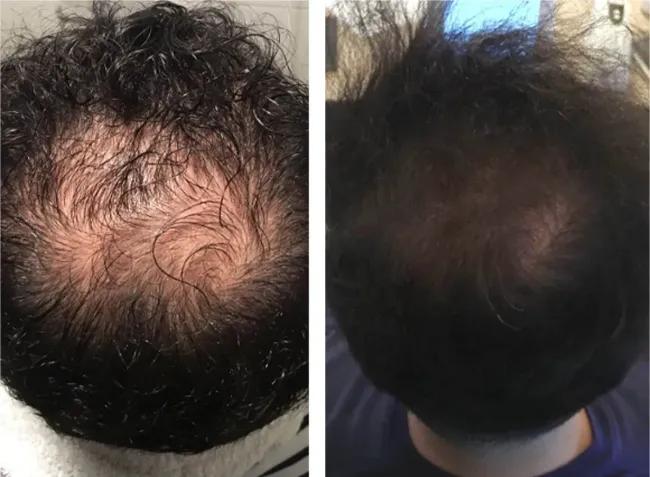 Fotos comparativas de un cuero cabelludo con adelgazamiento, calvicie y poco cabello en la parte superior.