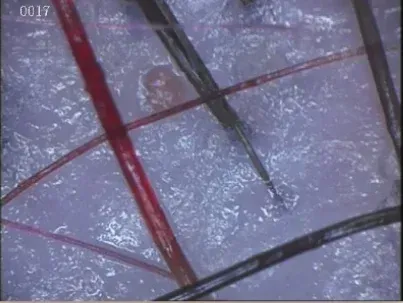 Primer plano de piel con folículos pilosos; pelos rojos y negros, fondo azul claro.