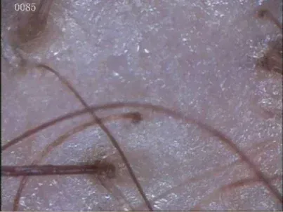 Primer plano de la piel y el pelo, posiblemente del cuero cabelludo, con pelos de color marrón claro emergiendo.