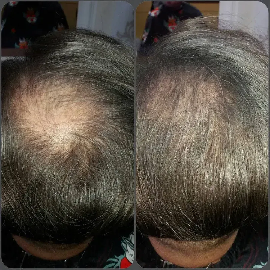 Dos vistas de arriba abajo de una cabeza que muestra pérdida de cabello.