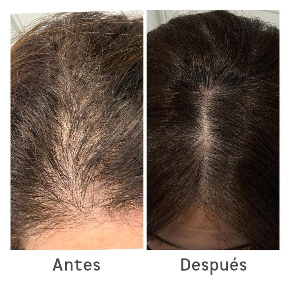 Primer plano del cuero cabelludo antes y después del tratamiento, que muestra una reducción del adelgazamiento del cabello y una mayor densidad capilar.