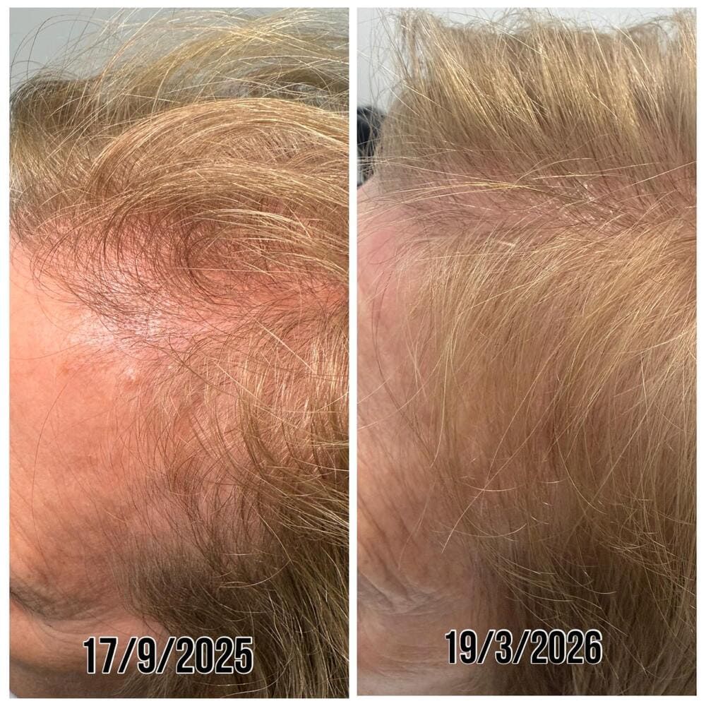 Primeros planos comparativos de cabello rubio claro y cuero cabelludo con adelgazamiento, con fecha del 17/9/2025 y 19/3/2026.