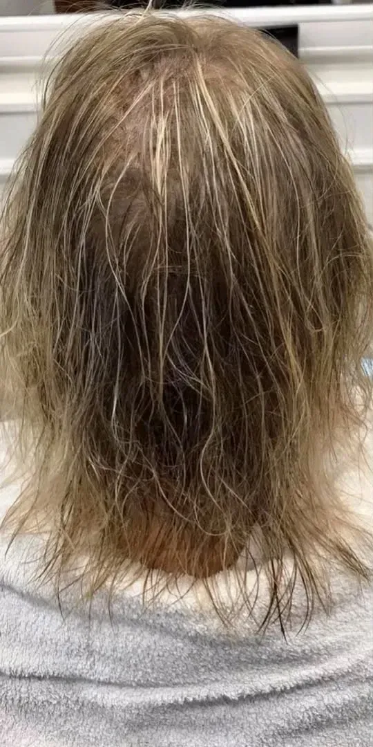 Parte posterior de la cabeza de una persona con cabello ralo, castaño claro y gris. Lleva una camiseta gris.