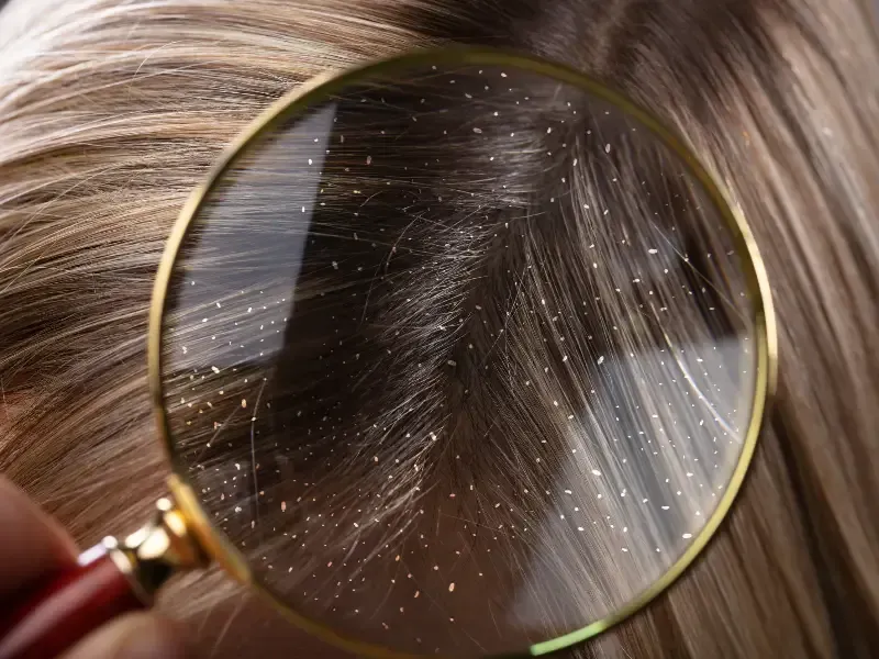 Lupa sobre cabello con escamas de caspa visibles.