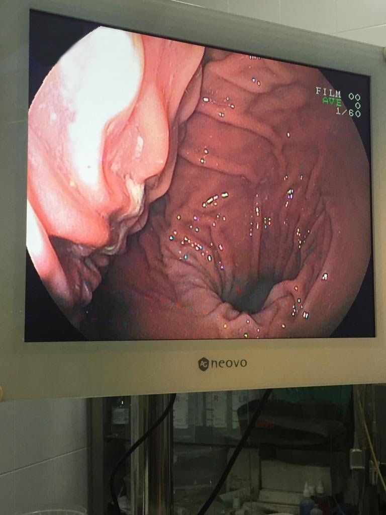 Un monitor Neova muestra una imagen del estómago de una persona.