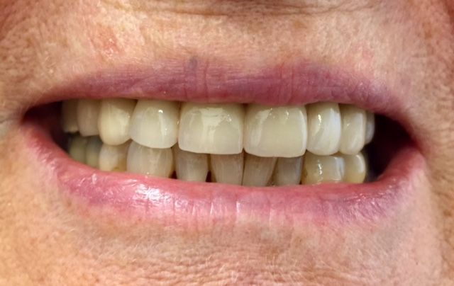 Vues du Pont Définitif