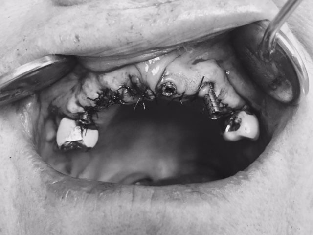 Extraction des dents- Pose Implants- Mise en charge Immédiate