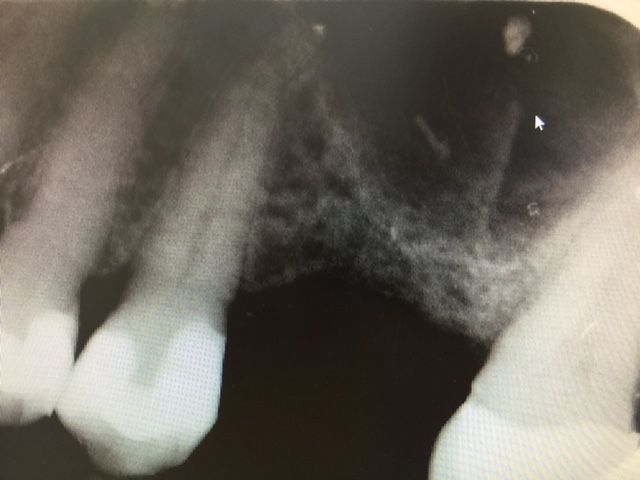 Greffe sinusienne - Avant intervention