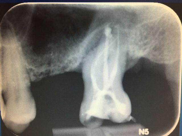 Greffe sinusienne - Avant intervention