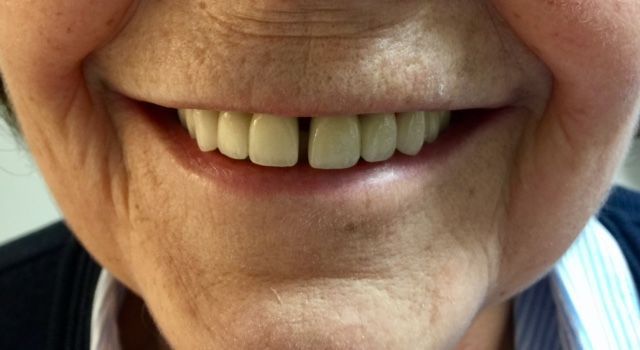 2 ponts définitifs vissés sur 6 implants