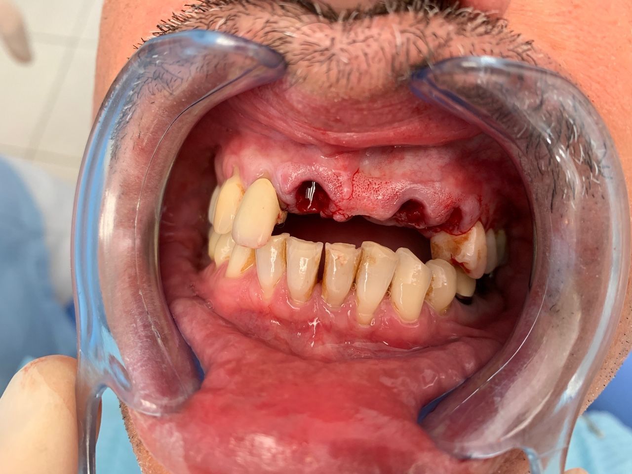 Chirurgie en une séance- Extraction des racines