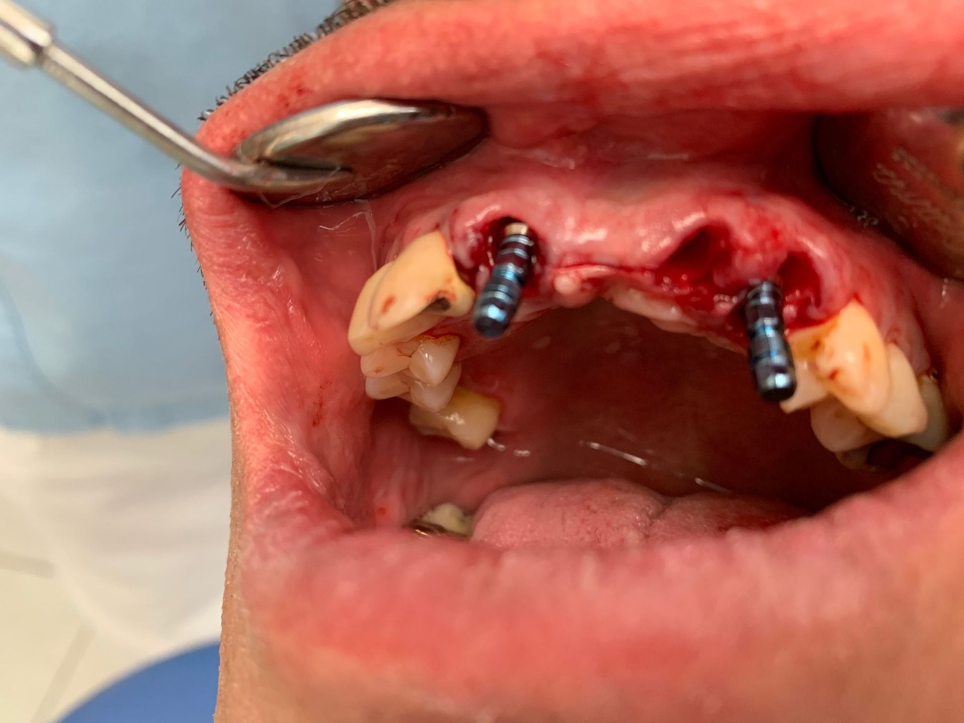 Mise en place des 2 Implants