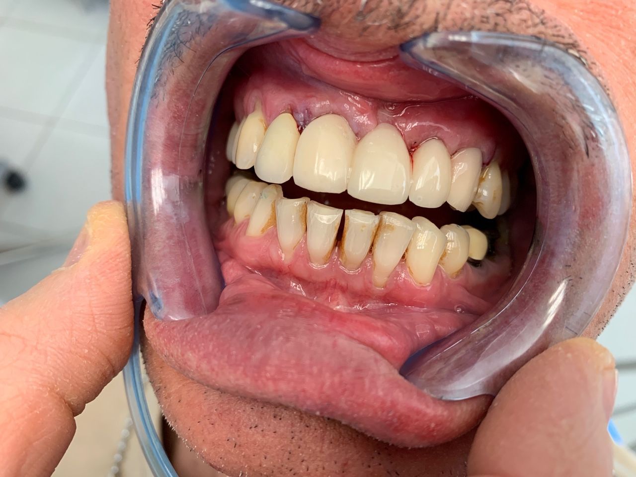 Pont Provisoire (jour de l'intervention)