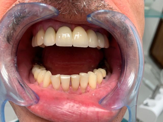 Pont définitif à 5 mois