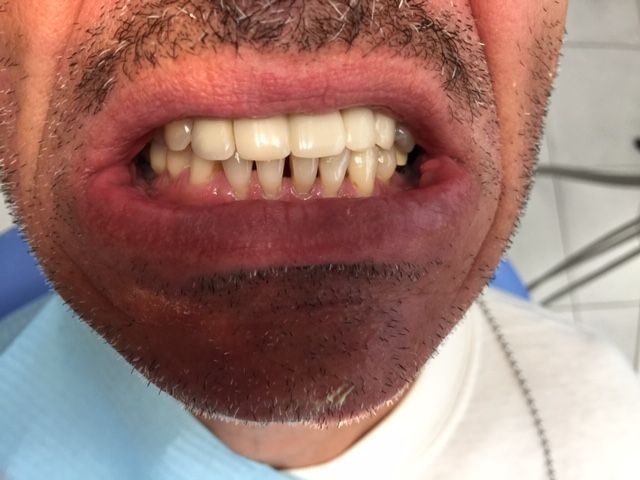 Pont définitif à 5 mois