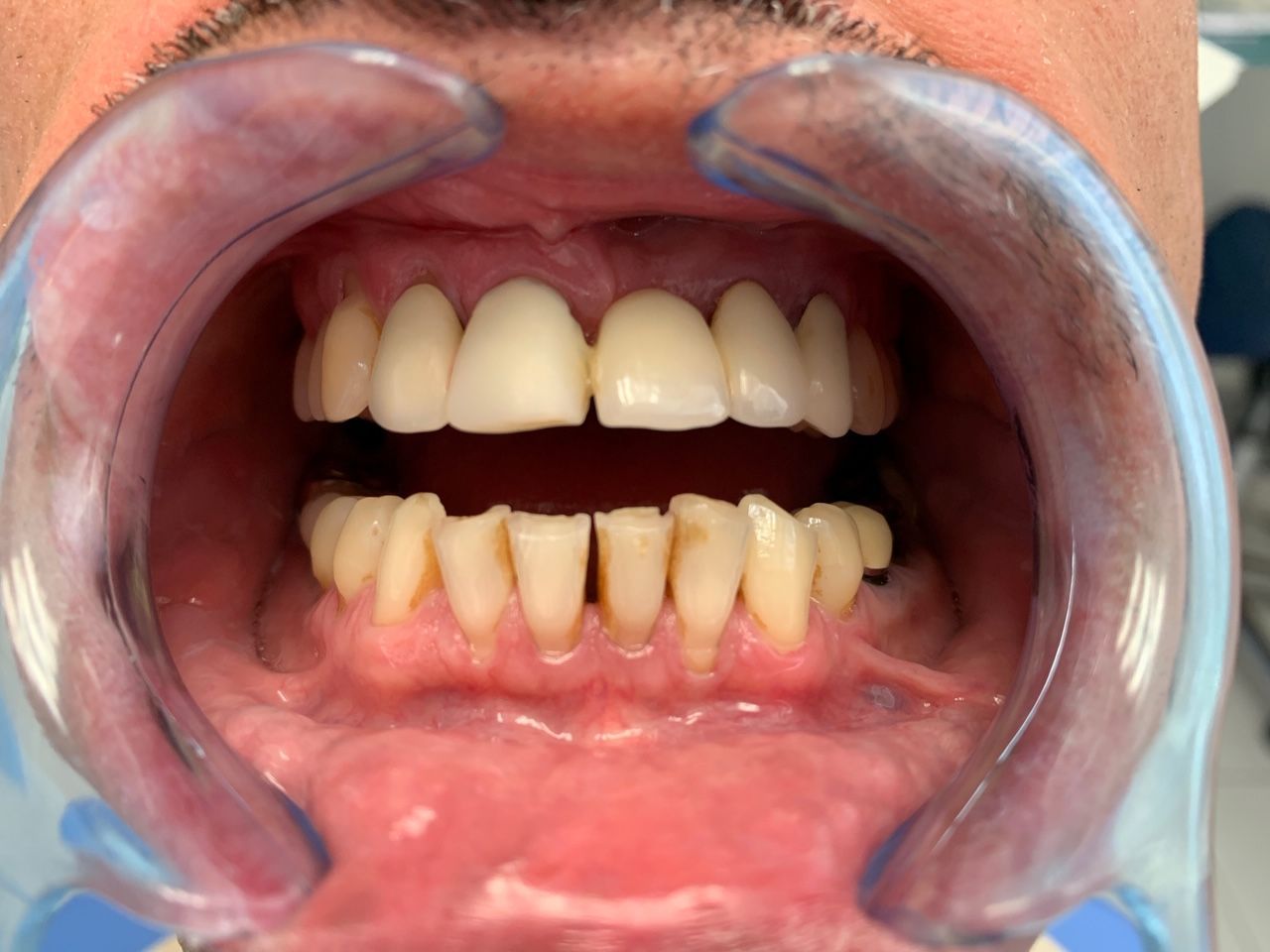 Pont fracturé au niveau des racines