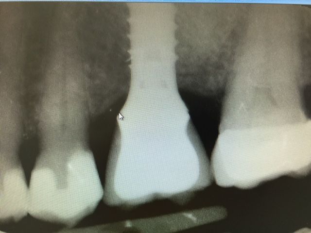 Greffe sinusienne - Couronne sur implant