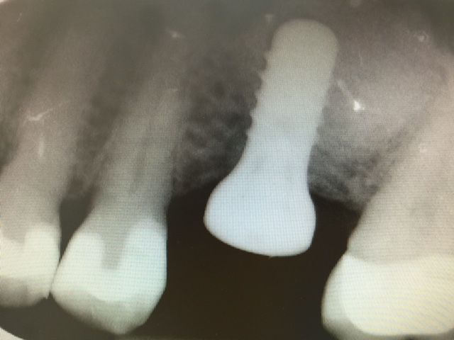Greffe sinusienne - Pose d'implant
