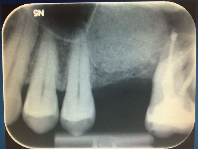Greffe sinusienne - Après intervention