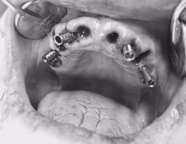 Extraction des dents- Pose Implants- Mise en charge Immédiate
