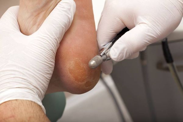 Hornhaut wird von einem Fuß entfernt